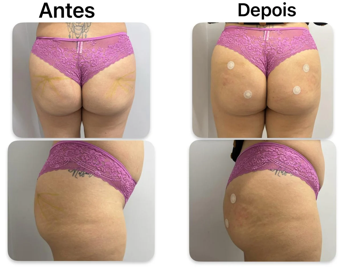 Antes e depois de cuidado corporal na Atual Estética — caso 4
